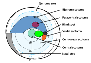 escotoma, escotoma centelleante,
tipos de escotomas,
escotoma y ansiedad